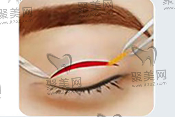 葛艳娜医生做双眼皮 葛艳娜医生做双眼皮