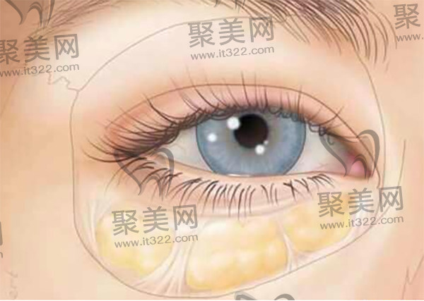 葛艳娜医生做双眼皮祛眼袋技术好 葛艳娜医生做双眼皮祛眼袋技术好
