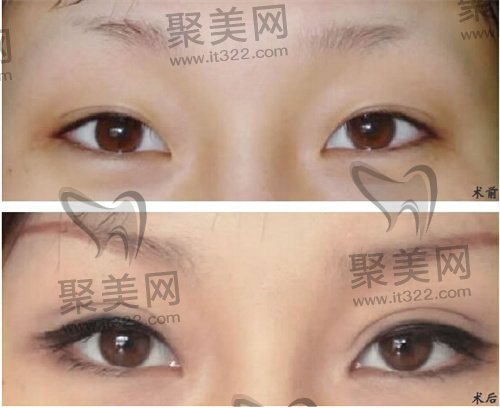 双眼皮 双眼皮
