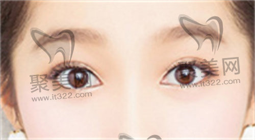 双眼皮 双眼皮