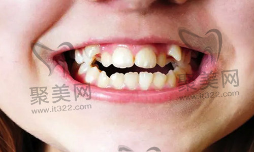 歪牙矫正 歪牙矫正