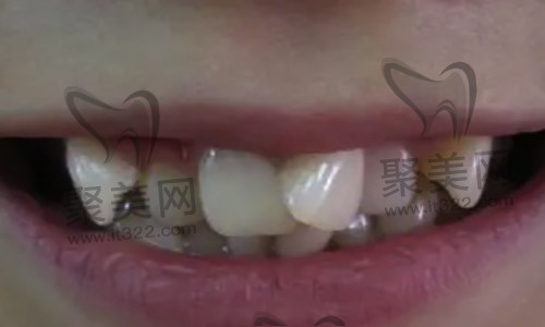 歪牙矫正 歪牙矫正