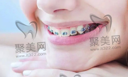 歪牙矫正 歪牙矫正