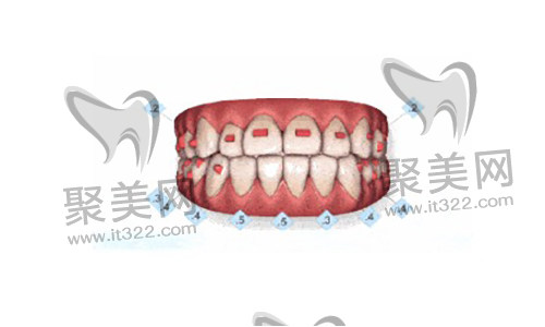 歪牙矫正 歪牙矫正