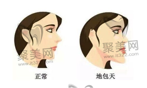 歪牙矫正 歪牙矫正