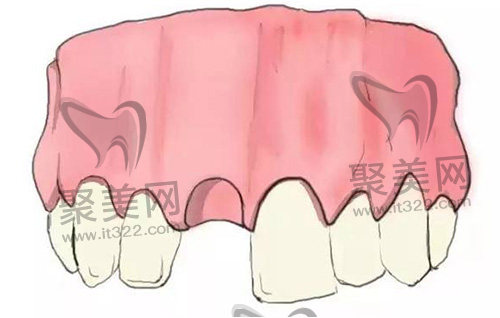 牙齿缺失 牙齿缺失