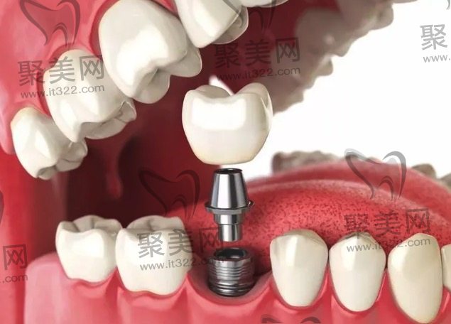 韩国登腾种植牙单颗种植牙价格 韩国登腾种植牙单颗种植牙价格
