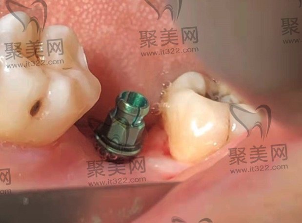 韩国登腾种植牙半口种植牙价格 韩国登腾种植牙半口种植牙价格