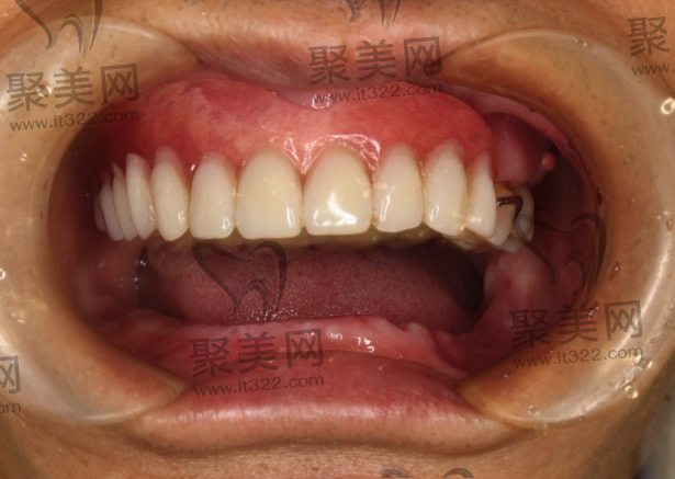 半口种植牙收费 半口种植牙收费