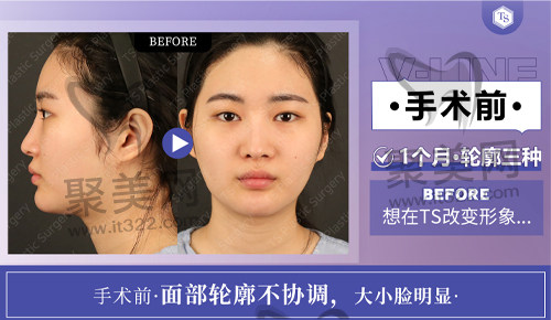 求美者手术前的样子 求美者手术前的样子