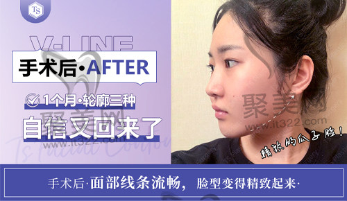 求美者做完面部整形一个月的恢复情况 求美者做完面部整形一个月的恢复情况