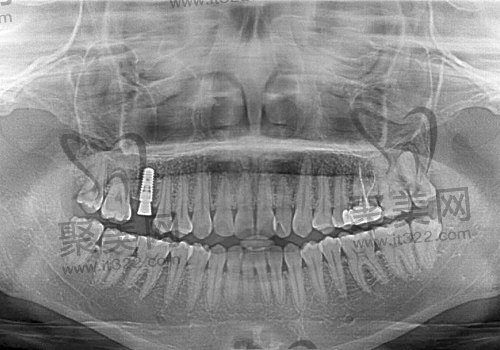 患者在植入ITI种植示意图 患者在植入ITI种植示意图