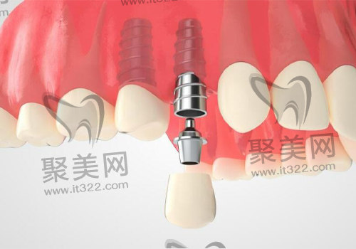 植入瑞士ITI士卓曼种植体 植入瑞士ITI士卓曼种植体