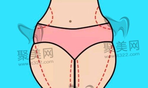 腰腹吸脂恢复期太难受了！抽脂20天了可以只晚上穿塑身衣吗