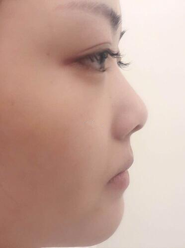 多彩的韩国纳米仿真隆鼻术怎么样?