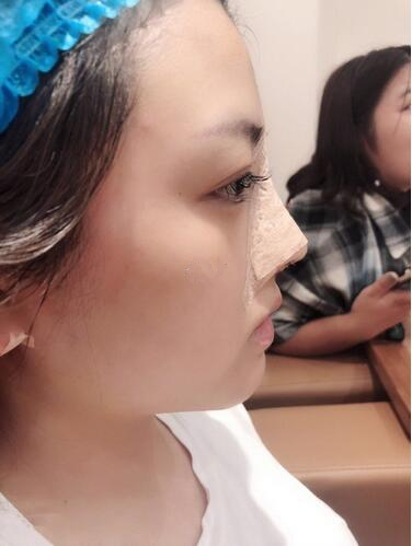 多彩的韩国纳米仿真隆鼻术怎么样?