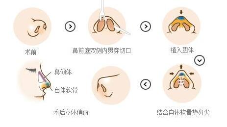 安利的五种隆鼻方法:都很不错哦!