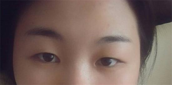 为何你的眼睛不好看?这是怎么回事?|尽美整形