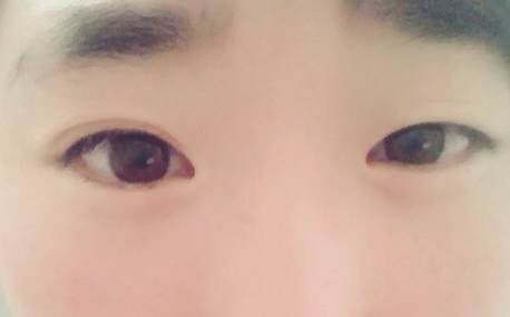 为何你的眼睛不好看?这是怎么回事?|尽美整形