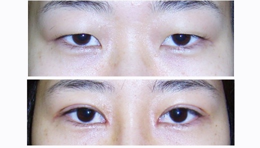 为何你的眼睛不好看?这是怎么回事?|尽美整形