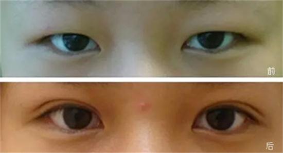 为何你的眼睛不好看?这是怎么回事?|尽美整形