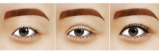 什么样的人适合*手术?