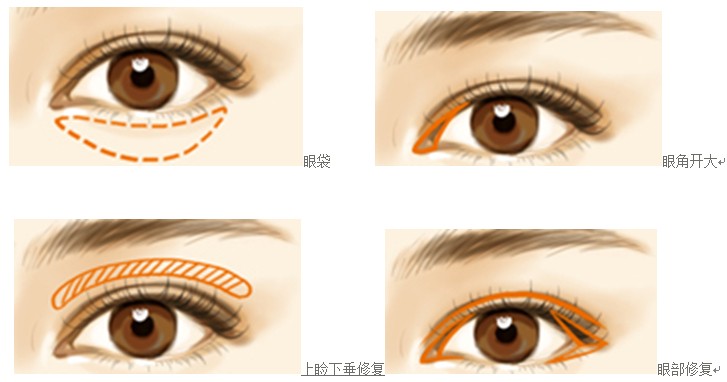 什么样的人适合*手术?