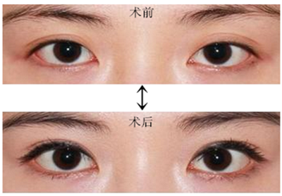 什么样的人适合*手术?