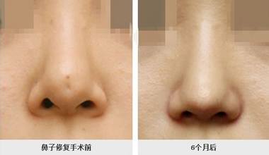 隆鼻失败好苦恼,该怎么修复?
