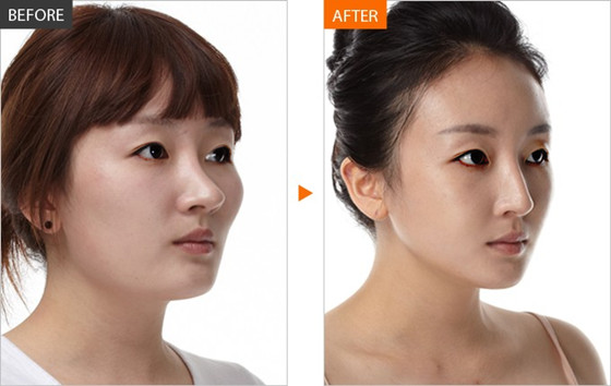 隆鼻失败好苦恼,该怎么修复?