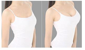 自体脂肪隆胸适合哪些人?|尽美网