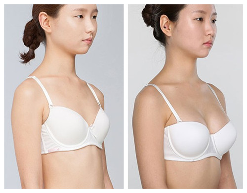 自体脂肪隆胸的优势有哪些?|尽美网