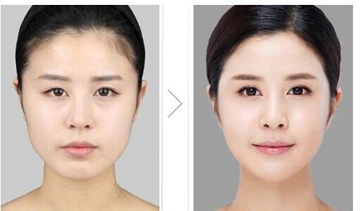 磨下颌角风险高吗?*高不高?|尽美网