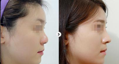 硅胶假体隆鼻适合哪些人做?|尽美网