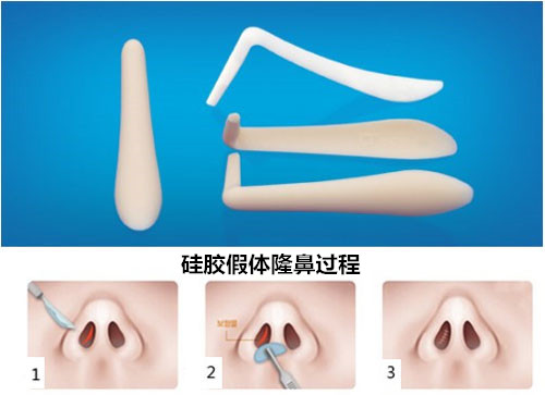 硅胶假体隆鼻适合哪些人做?|尽美网
