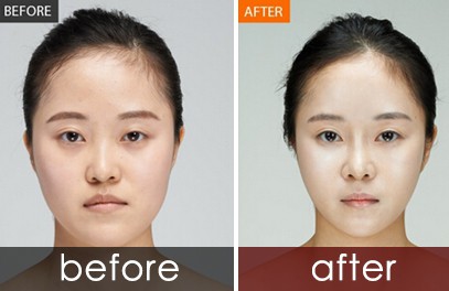 硅胶假体隆鼻适合哪些人做?|尽美网