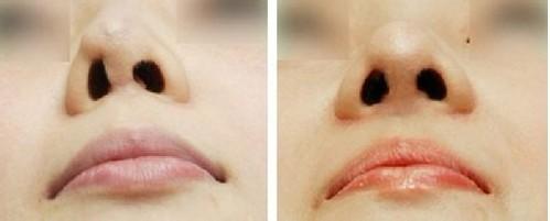 隆鼻手术失败需做二次手术应该如何选择?