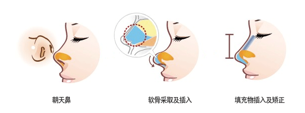 什么是朝天鼻?朝天鼻要怎么矫正?