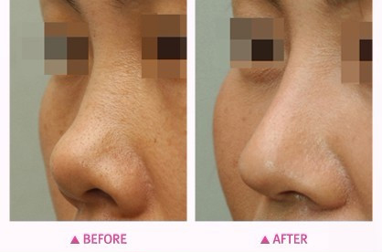 什么是朝天鼻?朝天鼻要怎么矫正?