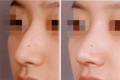 上海隆鼻失败修复术的费用是多少?