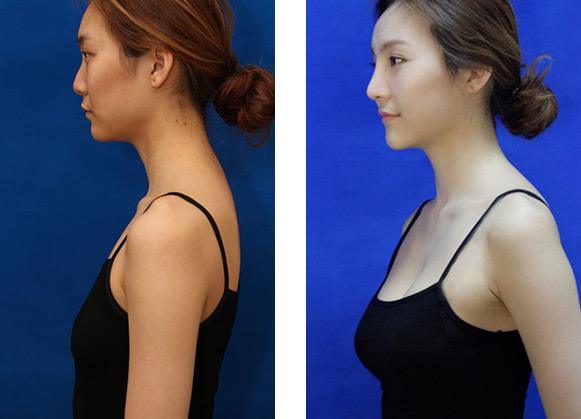 自体脂肪移植隆胸后吸收率高吗?