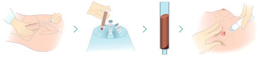 自体脂肪移植隆胸后吸收率高吗?