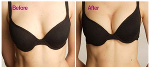 自体脂肪移植丰胸的费用是多少呢?