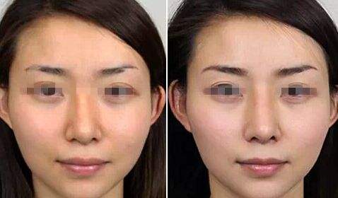 隆鼻失败修复手术前有哪些注意事项?