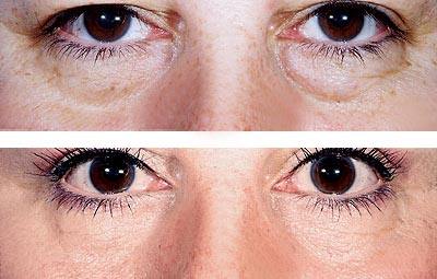 去眼袋手术会影响视力吗?