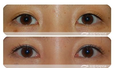 开内眼角手术的*果怎么样?
