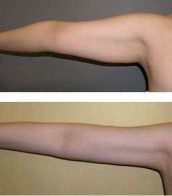 北京叶美人整形医院手臂吸脂多少钱?