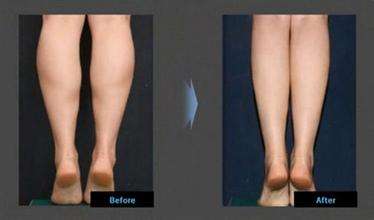 武汉协和整形医院小腿吸脂多少钱?