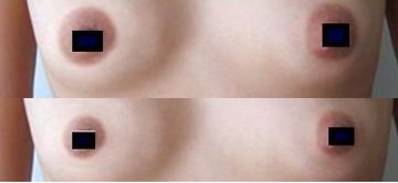 济南韩美整形医院乳晕缩小术多少钱?