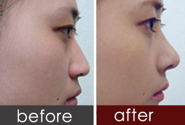 重庆天妃整形医院假体隆鼻多少钱?